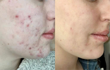 before and after hormonal acne with clarifying acne treatment oil skincare