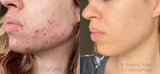 before and after acne with clarifying facial oil acne treatment
